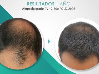 Alopecia - 790054