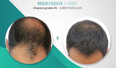 Alopecia - Mediarte