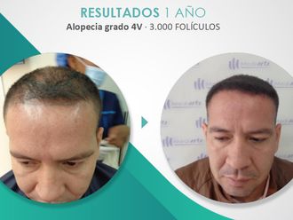 Alopecia - 790058