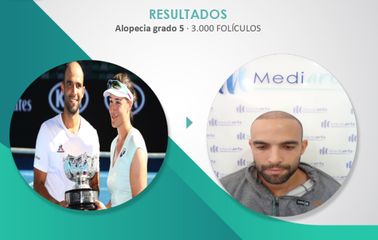 Alopecia - Mediarte