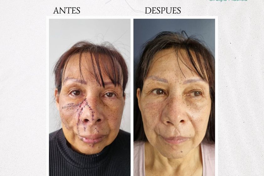 Cicatrices antes y después - 855429