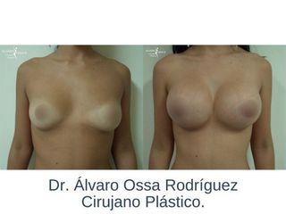 Mamoplastia de aumento - Dr. Álvaro Ossa