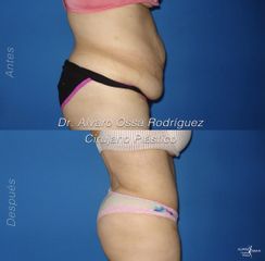 Abdominoplastia - Dr. Álvaro Ossa