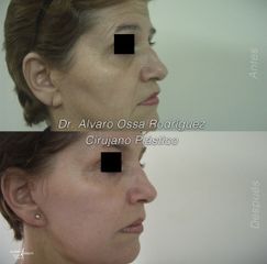 Ácido hialurónico - Dr. Álvaro Ossa