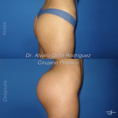 Gluteoplastia - Dr. Álvaro Ossa