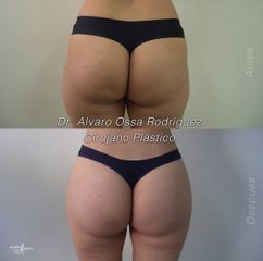 Gluteoplastia - Dr. Álvaro Ossa