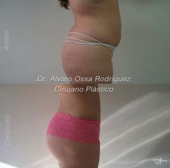 Liposucción - Dr. Álvaro Ossa