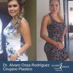 Liposucción - Dr. Álvaro Ossa