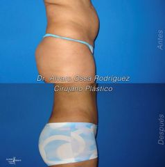 Abdominoplastia - Dr. Álvaro Ossa