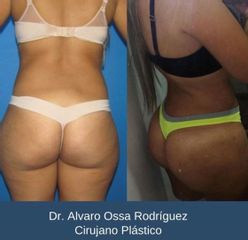 Liposucción - Dr. Álvaro Ossa