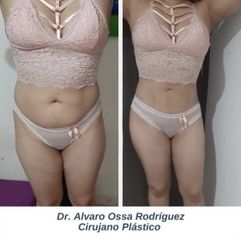 Liposucción - Dr. Álvaro Ossa