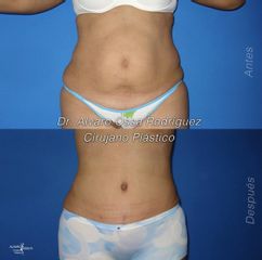 Abdominoplastia - Dr. Álvaro Ossa