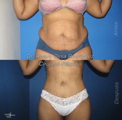 Abdominoplastia - Dr. Álvaro Ossa