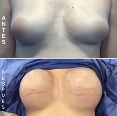 Mamoplastia de aumento - Dr. Álvaro Ossa