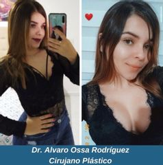 Mamoplastia de aumento - Dr. Álvaro Ossa