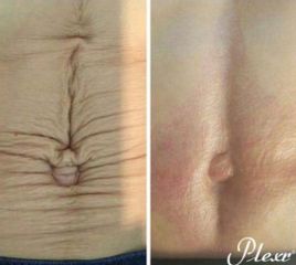 Abdominoplastia - Dr. Álvaro Ossa