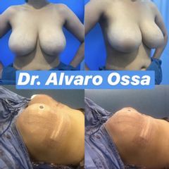 Mamoplastia de reducción - Dr. Álvaro Ossa