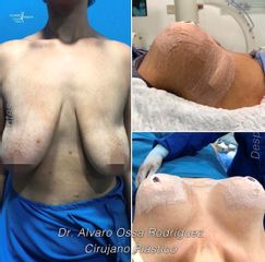 Levantamiento de senos - Dr. Álvaro Ossa