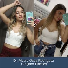 Mamoplastia de aumento - Dr. Álvaro Ossa