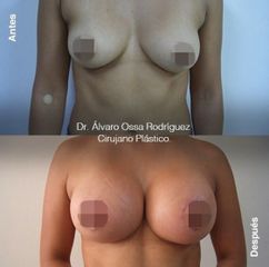 Mamoplastia de aumento - Dr. Álvaro Ossa