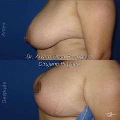Mamoplastia de reducción - Dr. Álvaro Ossa