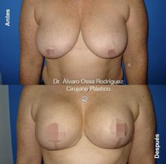 Mamoplastia de reducción - Dr. Álvaro Ossa