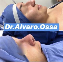 Rinoplastia - Dr. Álvaro Ossa