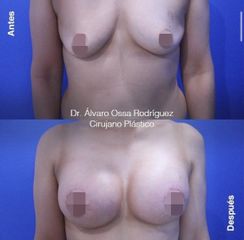 Mamoplastia de aumento - Dr. Álvaro Ossa