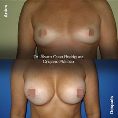 Mamoplastia de aumento - Dr. Álvaro Ossa