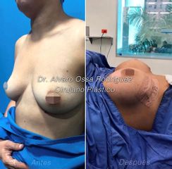 Mamoplastia de aumento - Dr. Álvaro Ossa