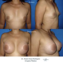 Mamoplastia de aumento - Dr. Álvaro Ossa