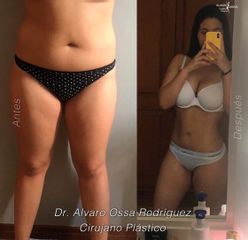 Liposucción - Dr. Álvaro Ossa
