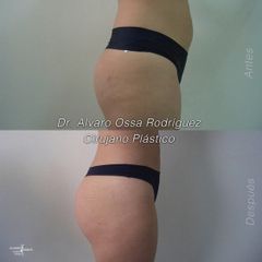 Gluteoplastia - Dr. Álvaro Ossa