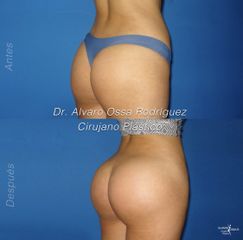 Gluteoplastia - Dr. Álvaro Ossa