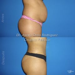 Abdominoplastia - Dr. Álvaro Ossa