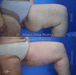 Liposucción - Dr. Álvaro Ossa