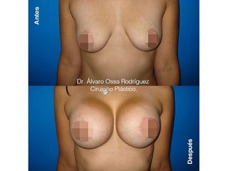Mamoplastia de aumento - Dr. Álvaro Ossa