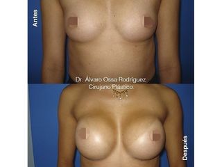 Mamoplastia de aumento - Dr. Álvaro Ossa