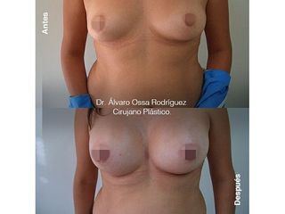 Mamoplastia de aumento - Dr. Álvaro Ossa