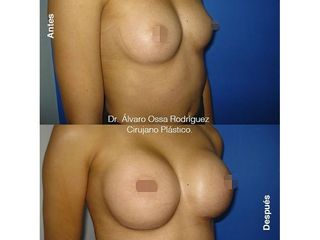 Mamoplastia de aumento - Dr. Álvaro Ossa