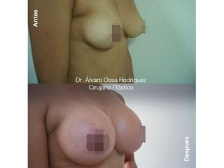 Mamoplastia de aumento - Dr. Álvaro Ossa