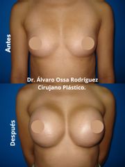 Mamoplastia de aumento - Dr. Álvaro Ossa