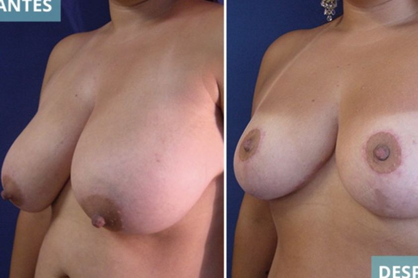 Mamoplastia de reducción antes y después - 611468
