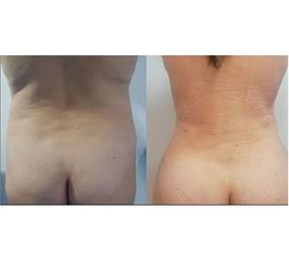 Lipoescultura 