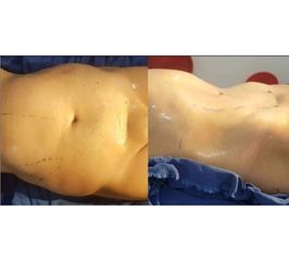 Lipoescultura 
