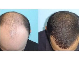 Alopecia - 660521