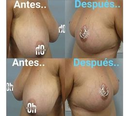 Aumento mamario