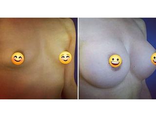 Mamoplastia de aumento - Dr. Juan A. Sanabria