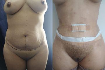 Abdominoplastia - Dr. Juan A. Sanabria