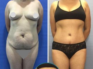 ABDOMINOPLASTIA 1